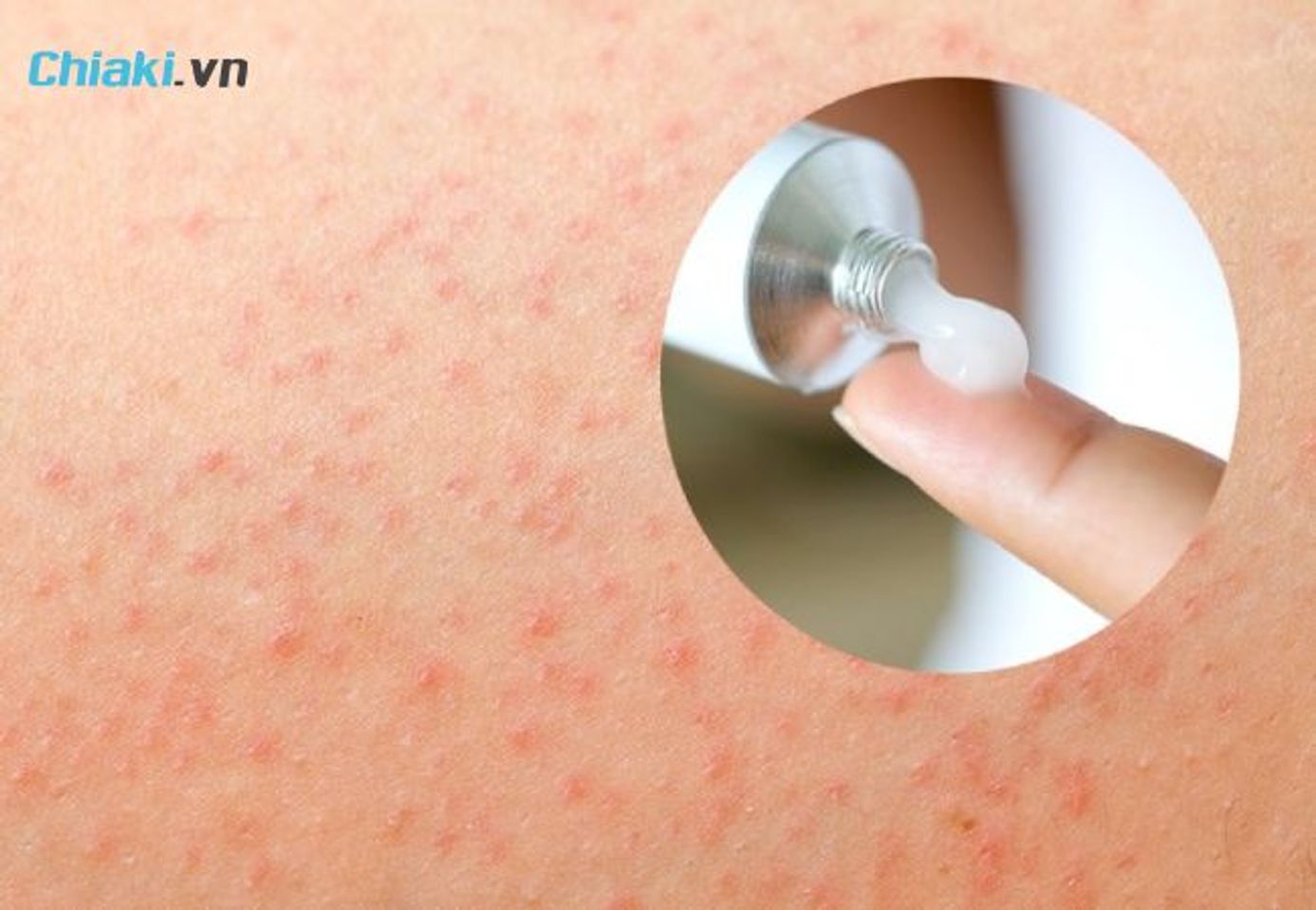 C&aacute;ch chọn kem trị vi&ecirc;m nang l&ocirc;ng tốt