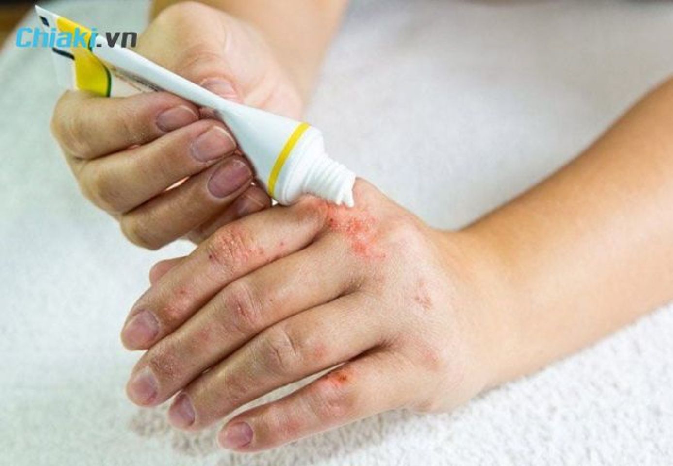 ưu điểm của thuốc b&ocirc;i vi&ecirc;m da cơ địa
