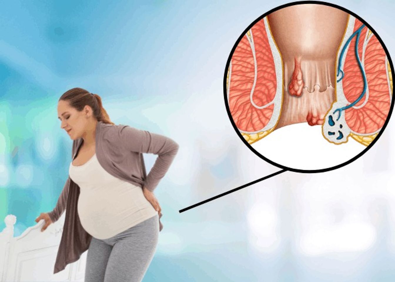 Tại sao khi mang thai mẹ bầu thường bị trĩ?