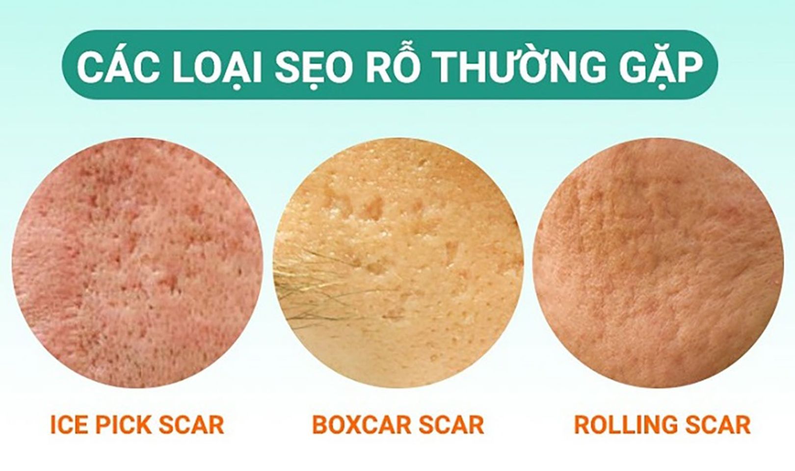 Những nguy&ecirc;n nh&acirc;n n&agrave;o dẫn đến sẹo rỗ tr&ecirc;n da?