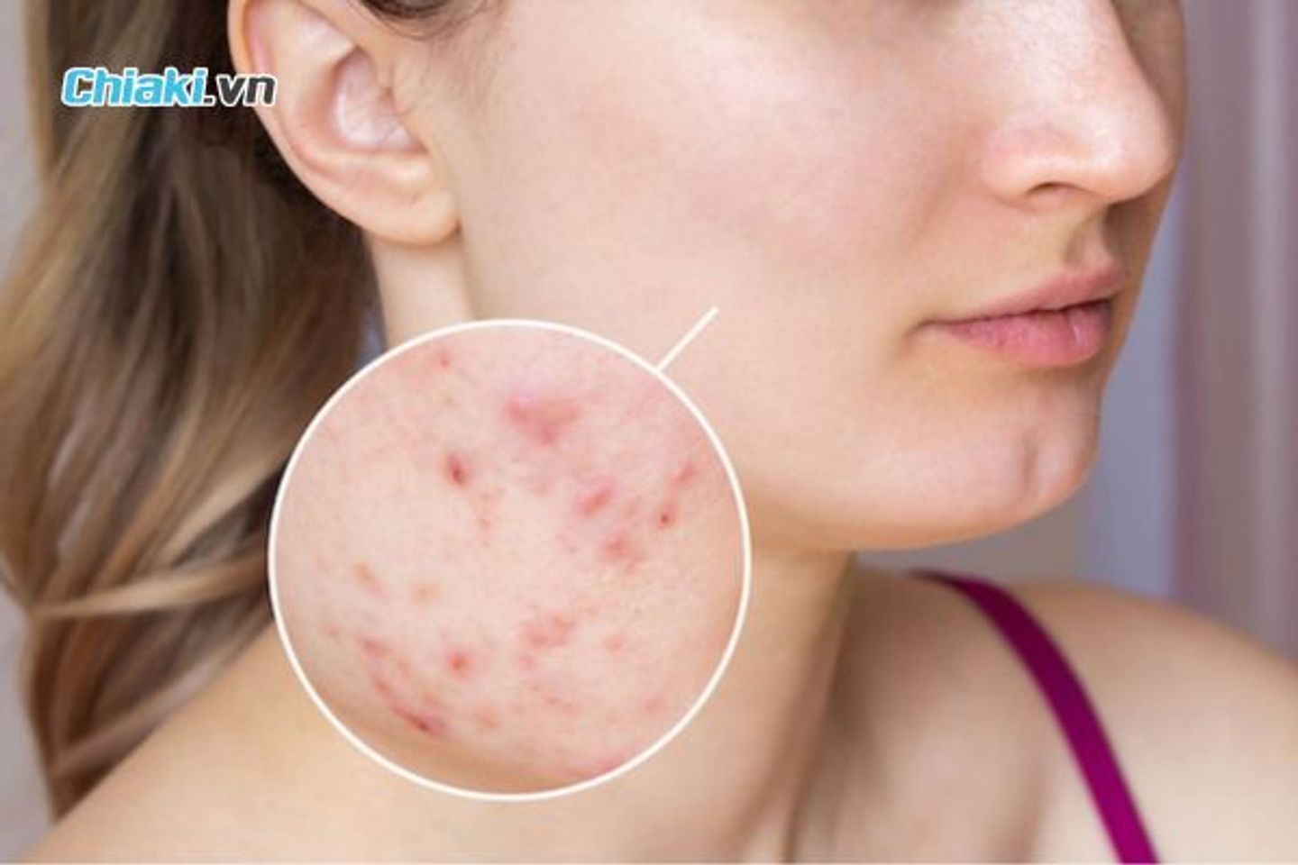Uống thuốc m&aacute;t gan c&oacute; hết mụn kh&ocirc;ng?