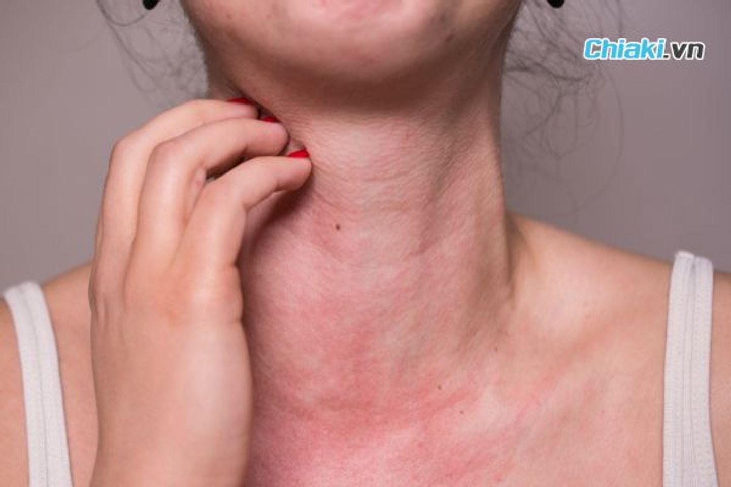 Người c&oacute; cơ địa dễ bị dị ứng