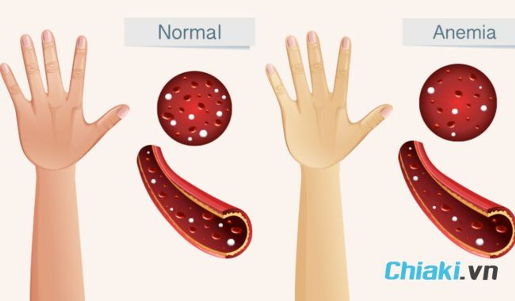 Dấu hiệu trẻ thiếu sắt l&agrave; da xanh xao