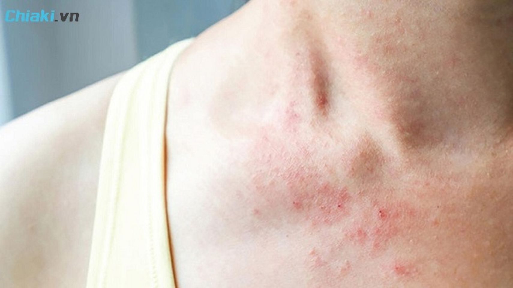 Người c&oacute; tiền sử dị ứng với c&aacute;c th&agrave;nh phần của tinh dầu th&ocirc;ng đỏ