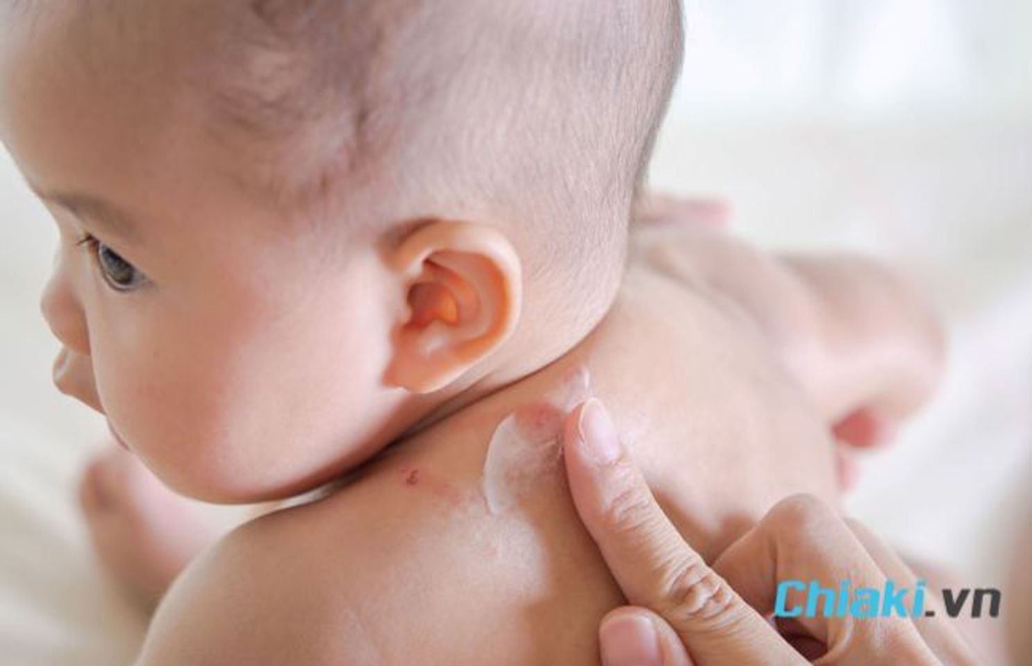 Bổ sung kẽm khi trẻ sơ sinh thường xuy&ecirc;n mắc vấn đề về da