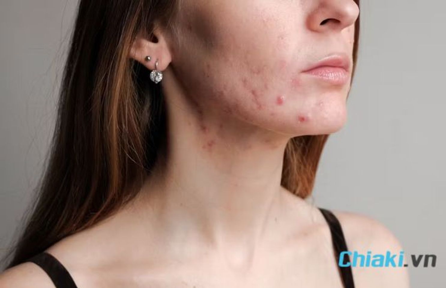 Dấu hiệu thiếu kẽm - Da dễ nổi mụn