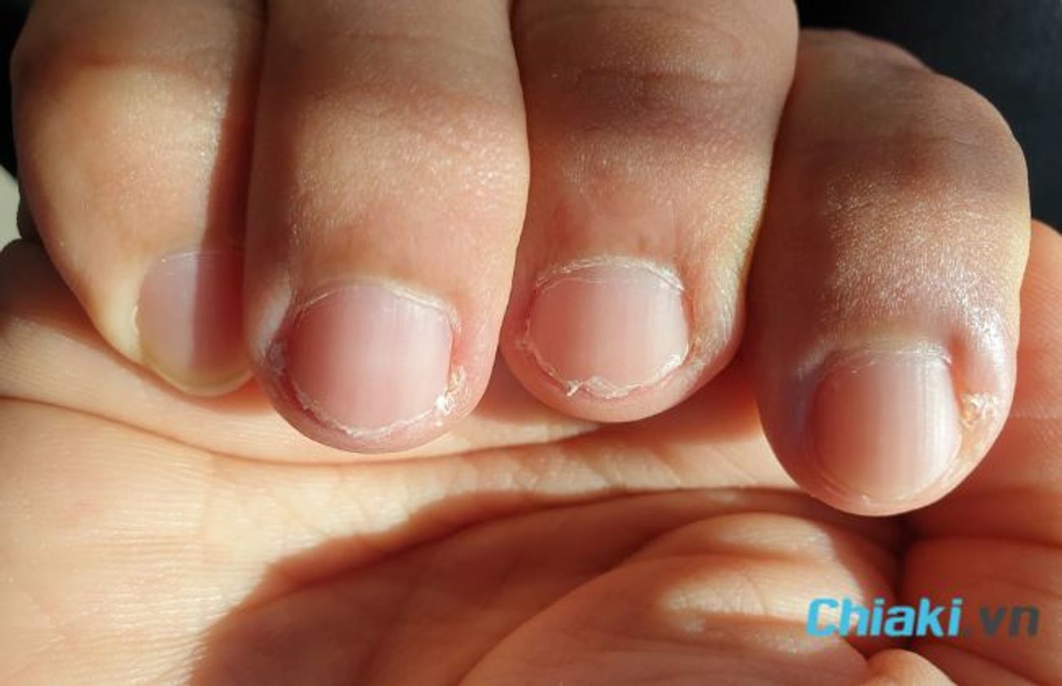 Dấu hiệu thiếu kẽm - M&oacute;ng tay gi&ograve;n