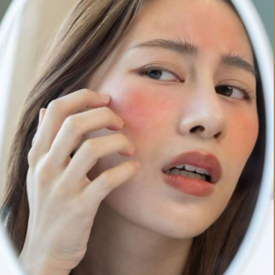 Kem chống nắng c&oacute; thể g&acirc;y dị ứng v&agrave; k&iacute;ch ứng da