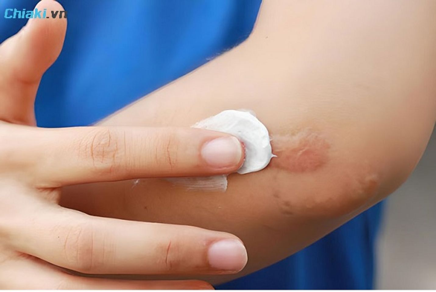 Lu&ocirc;n d&ugrave;ng kem chống nắng (SPF 30 trở l&ecirc;n) khi ra ngo&agrave;i để vết sẹo kh&ocirc;ng bị th&acirc;m