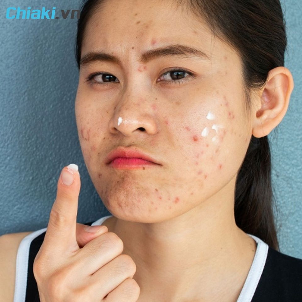 Nổi mụn - Một trong những t&aacute;c hại từ kem chống nắng