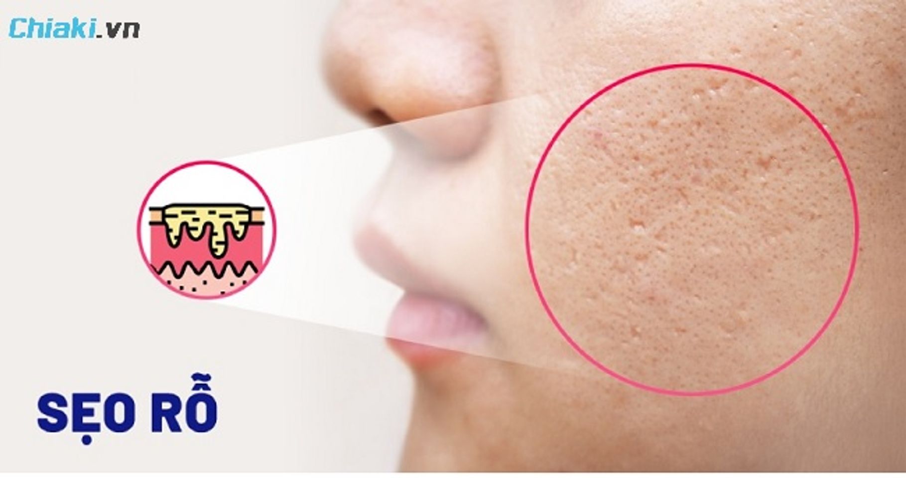 Sẹo rỗ c&oacute; lỗ ch&acirc;n l&ocirc;ng to hơn b&igrave;nh thường