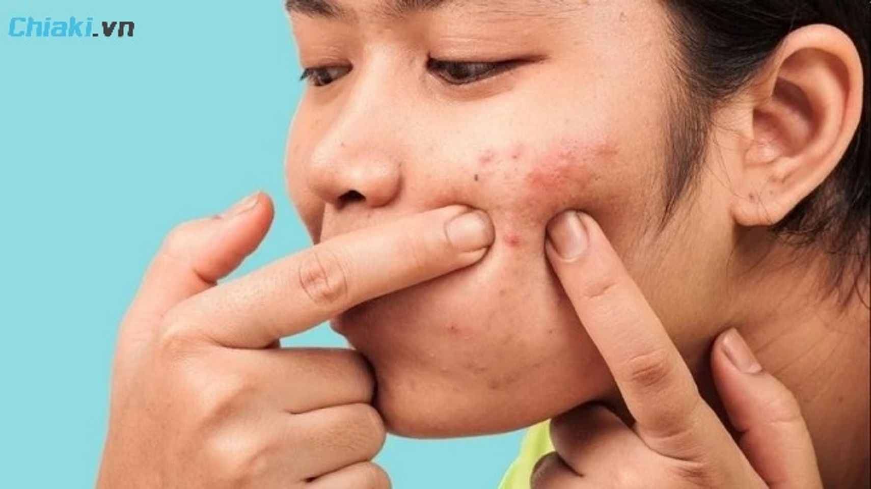 Trong qu&aacute; tr&igrave;nh phục hồi da bị rỗ, tuyệt đối kh&ocirc;ng được nặn mụn