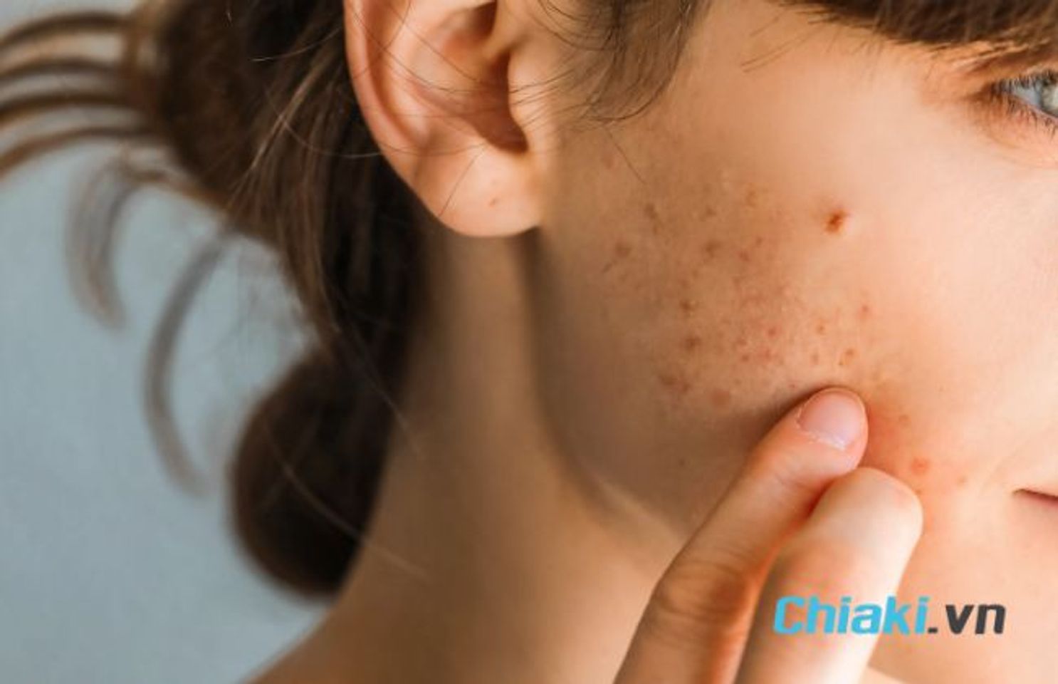 Serum B5 c&oacute; đẩy mụn kh&ocirc;ng