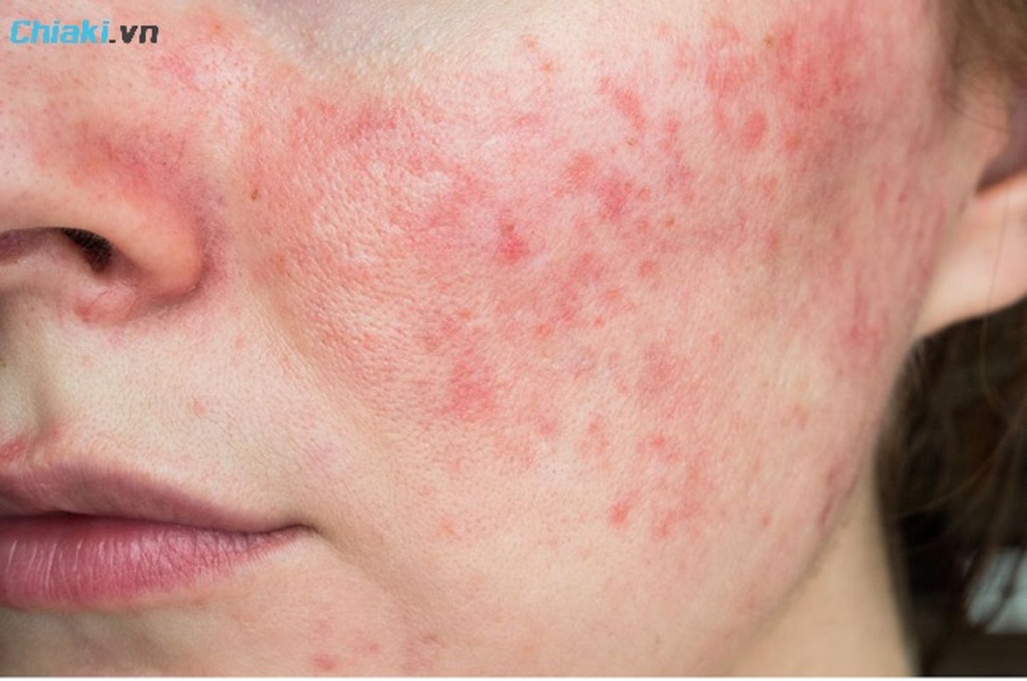 Da treatment l&agrave; biện ph&aacute;p can thiệp chuy&ecirc;n biệt tới da nhằm cải thiện sức khỏe, chức năng hoặc thẩm mỹ của da