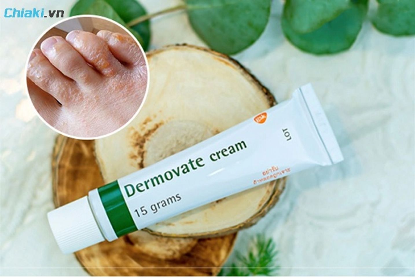 Thuốc b&ocirc;i Demovate giảm ngứa v&agrave; sưng vi&ecirc;m nhanh chỉ sau v&agrave;i ng&agrave;y sử dụng