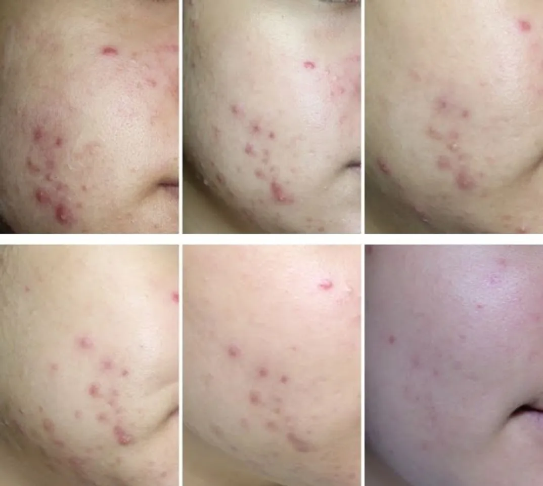 Độ hiệu quả Gel Ngừa Mụn Naris Cosmetic Acne Grand Medicated Concentrate Gel Spots 20g