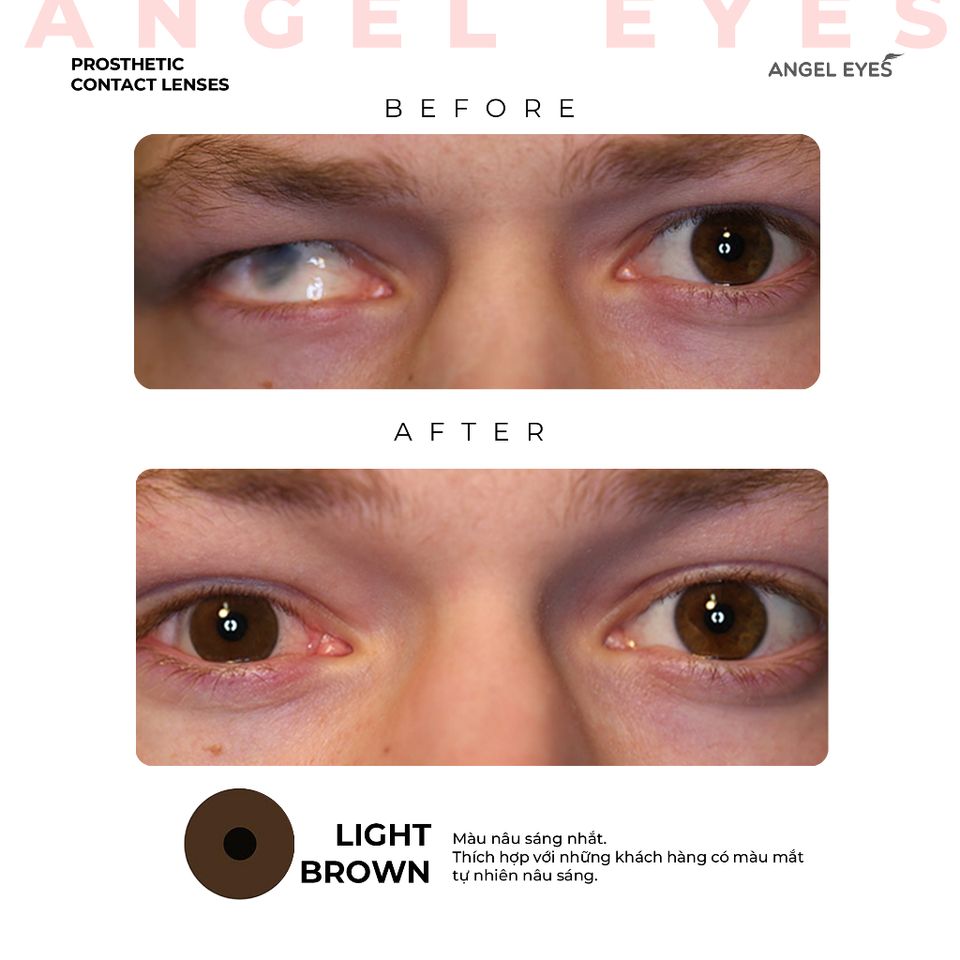 Kính áp tròng thẩm mỹ Angel Eyes - Lens che khuyết điểm cho mắt bị đục thủy tinh thể, cườm, thiết kế thời trang Hàn Quốc