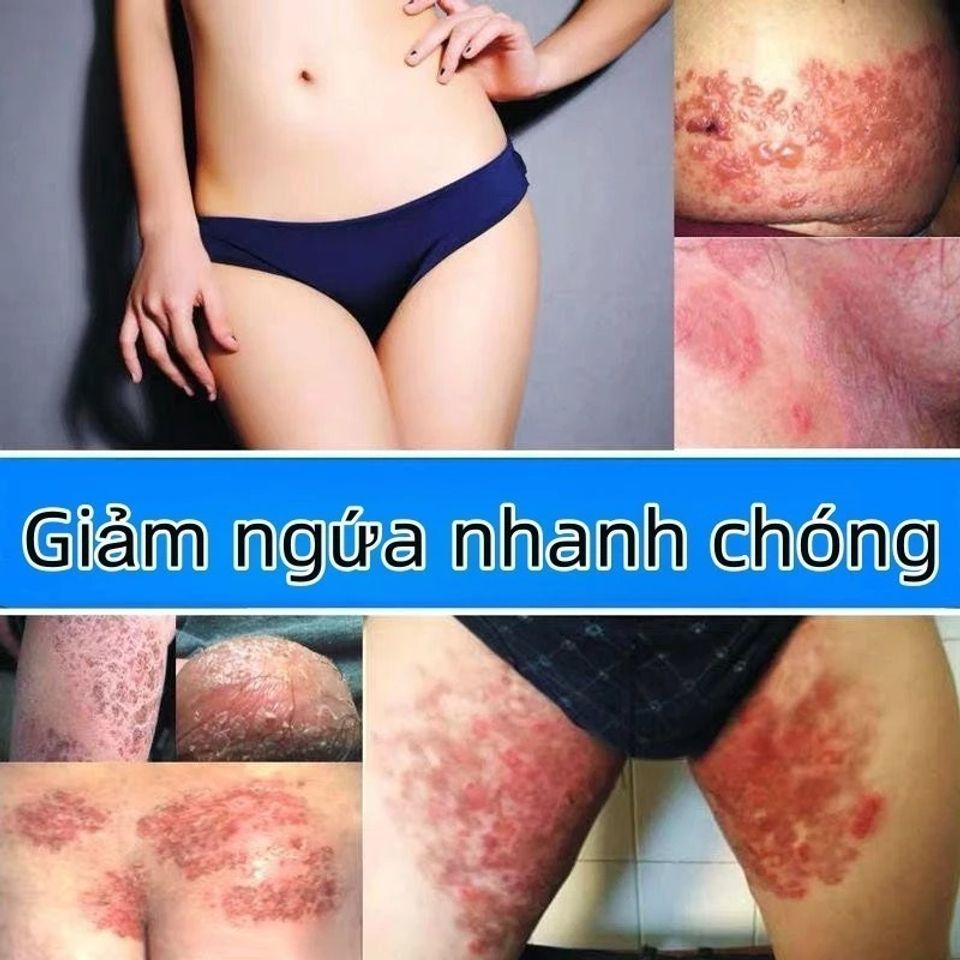 Kem Bôi Đa Năng Nhật Bản Giảm Ngứa - Hỗ Trợ Điều Trị Nấm Da, Hắc Lào, Vảy Nến, Tổ Đỉa - An Toàn Cho Mọi Loại Da