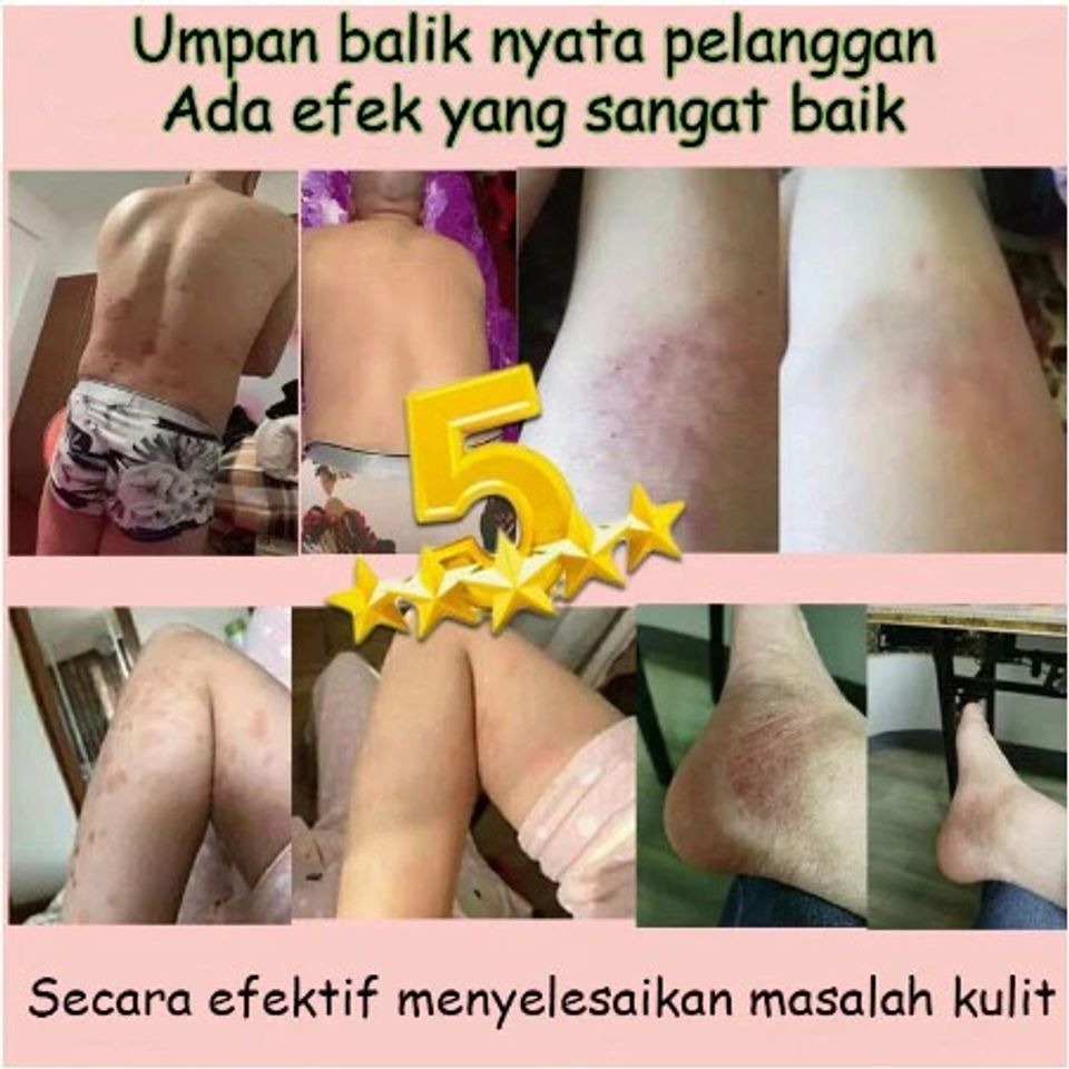 Kem Bôi Đa Năng Nhật Bản Giảm Ngứa - Hỗ Trợ Điều Trị Nấm Da, Hắc Lào, Vảy Nến, Tổ Đỉa - An Toàn Cho Mọi Loại Da