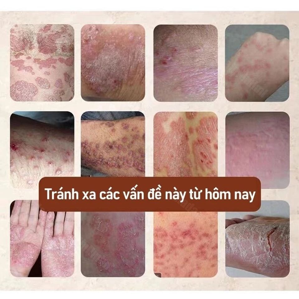Kem Bôi Đa Năng Nhật Bản Giảm Ngứa - Hỗ Trợ Điều Trị Nấm Da, Hắc Lào, Vảy Nến, Tổ Đỉa - An Toàn Cho Mọi Loại Da