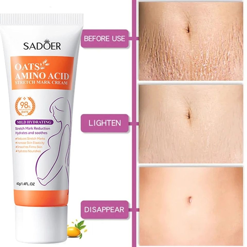 Kem Làm Mờ Rạn Da Anti-Stretch Marks Cream Cho Bà Bầu - Giúp Tái Tạo Da, Giảm Sẹo và Thâm, An Toàn Cho Làn Da Nhạy Cảm