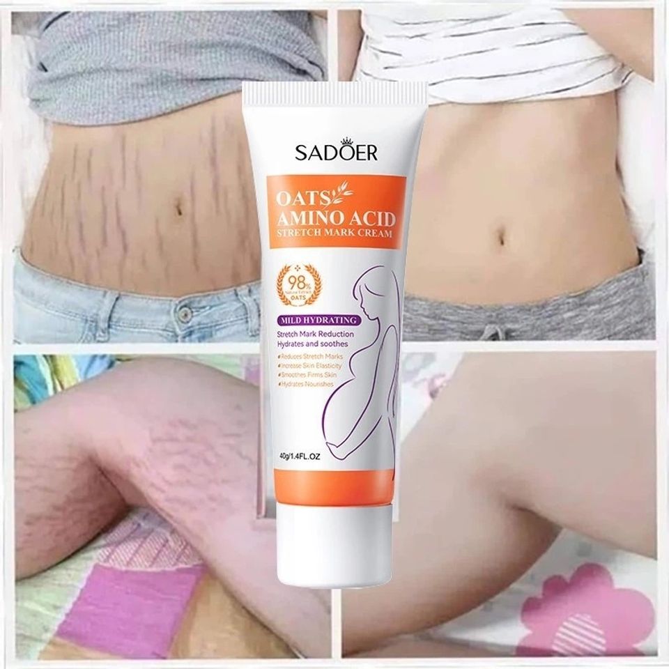 Kem Làm Mờ Rạn Da Anti-Stretch Marks Cream Cho Bà Bầu - Giúp Tái Tạo Da, Giảm Sẹo và Thâm, An Toàn Cho Làn Da Nhạy Cảm