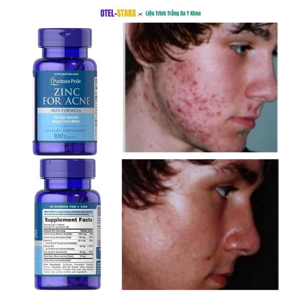 Viên Kẽm Hỗ Trợ Giải Quyết Mụn Zinc for Acne Puritan's Pride 100 Viên - Cải Thiện Da Mụn Hiệu Quả Từ Mỹ Chính Hãng