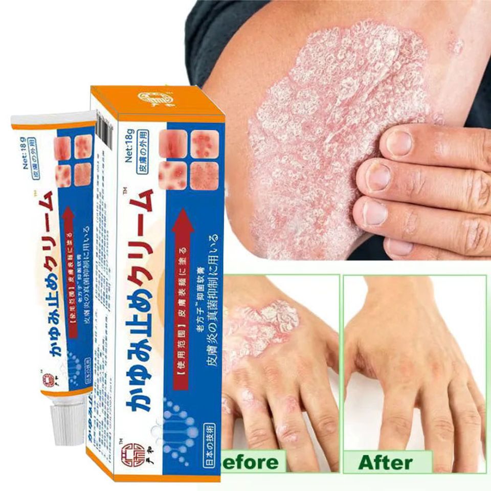 Kem bôi vẩy nến ngứa viêm da,nấm da,tổ đỉa,ghẻ,á sừng,hắc lào,mề đay,dị ứng,Nhẹ nhàng không kích thíc,Tẩy tế bào chết
