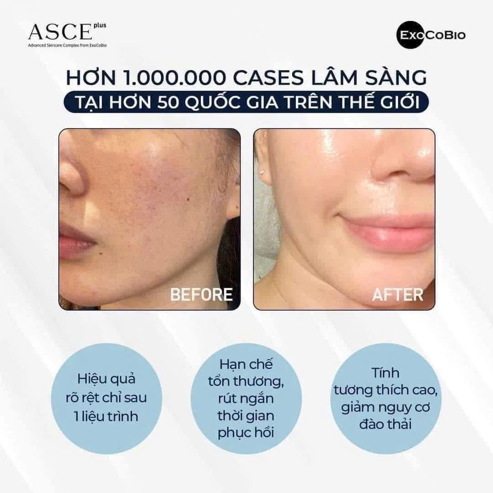 Exosome Asce+ tế bào gốc căng bóng da phục hồi căng bóng