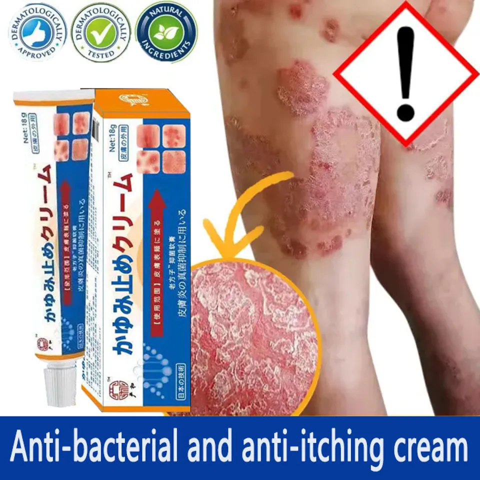 Kem bôi vẩy nến ngứa viêm da,nấm da,tổ đỉa,ghẻ,á sừng,hắc lào,mề đay,dị ứng,Nhẹ nhàng không kích thíc,Tẩy tế bào chết